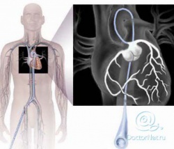 На рисунке показано расположение диагностического
катетера при проведения коронарографии.